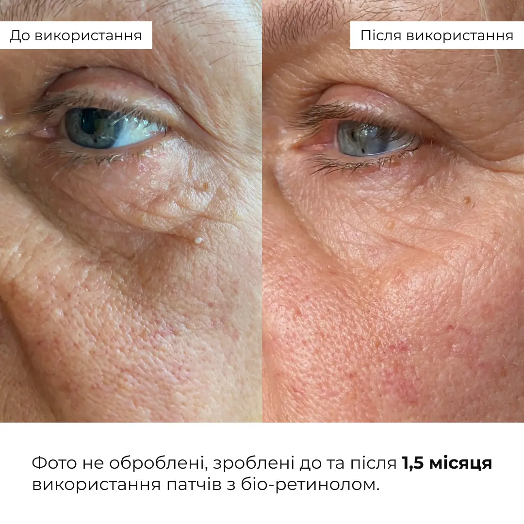 Розгладжувальні патчі з біо-ретинолом Hillary Bacuchiol Wrinkle Correcting & Eye Lift Patches, HI-08-673 11